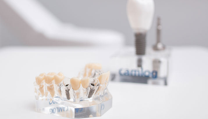 Gebissmodell mit Zahnimplantaten zeigt die Position der Implantate in der Zahnarztpraxis Offermanns in Herzogenrath.